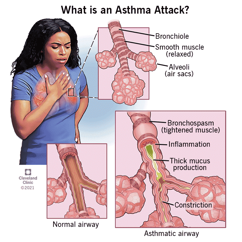 15+ Asthma Essay Topics & Research Questions + Best Asthma Research Article Examples