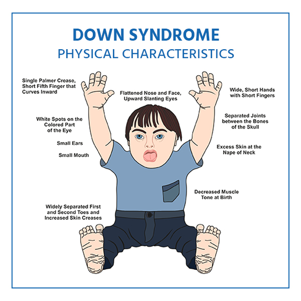 50+ Best Down Syndrome Essay Topics + 1 Free Down Syndrome Article