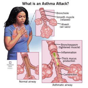signs-and-symptoms of asthma Essay