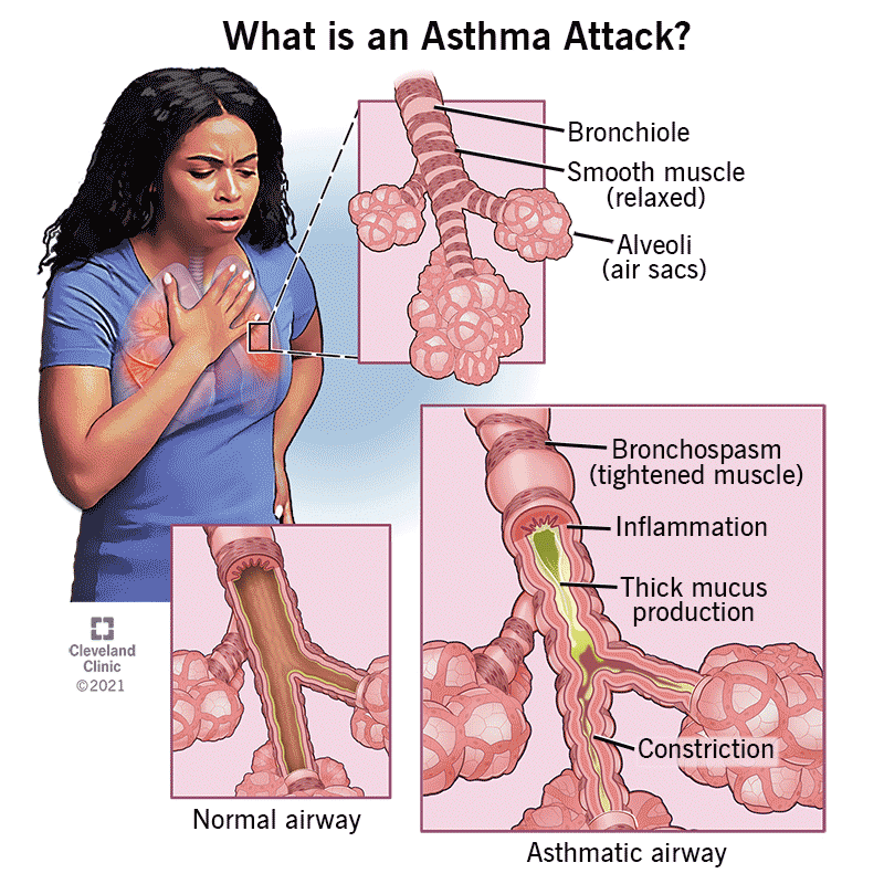 15+ Asthma Essay Topics & Research Questions + Best Asthma Research Article Examples
