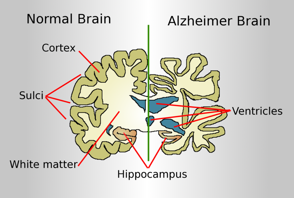 Alzheimer's Disease Essay Topics