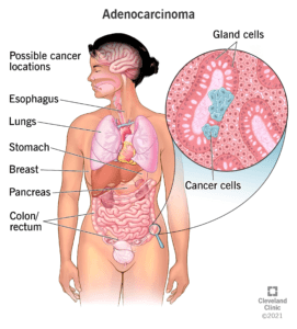 Gastric cancer essay summary