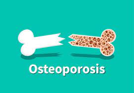 Osteoporosis Essay Topics