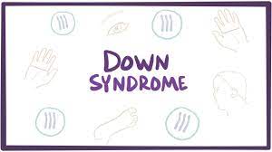 Down Syndrome Essay Topics