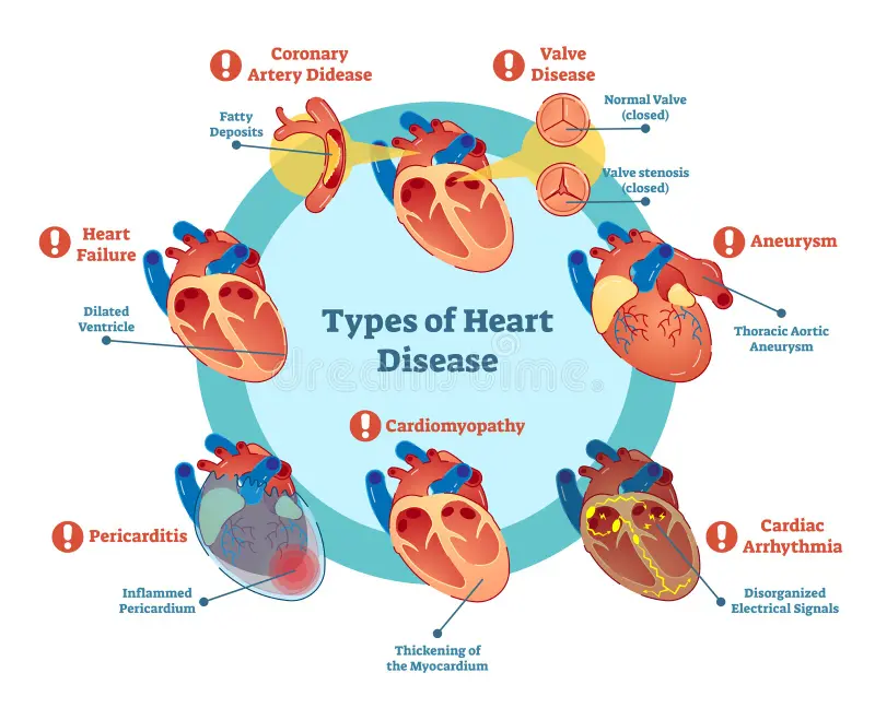Heart Disease-Nursing Paper Examples